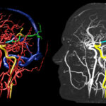 Maximum intensity projection of the head vessels from CT