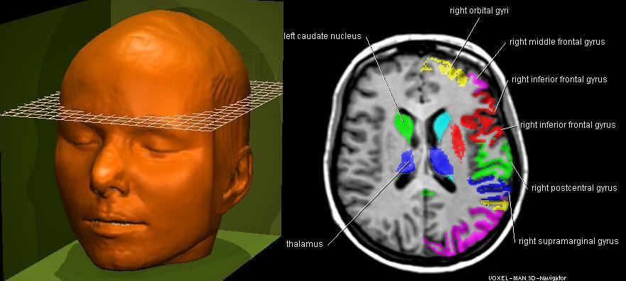 MRI images of the brain