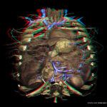 Stereoscopic view of the open thorax