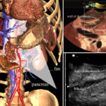 Training system for linear type endoscopic ultrasound (EUS)