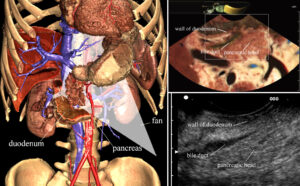 Training system for linear type endoscopic ultrasound (EUS)