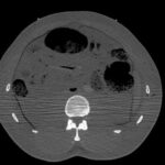 SIO Frozen CT image