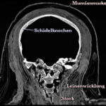 Reconstructed coronal cross-section