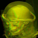 Mummy with transparent cover in red/green stereo